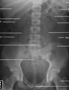 7}  Abdominal X Ray Report Template Pdf