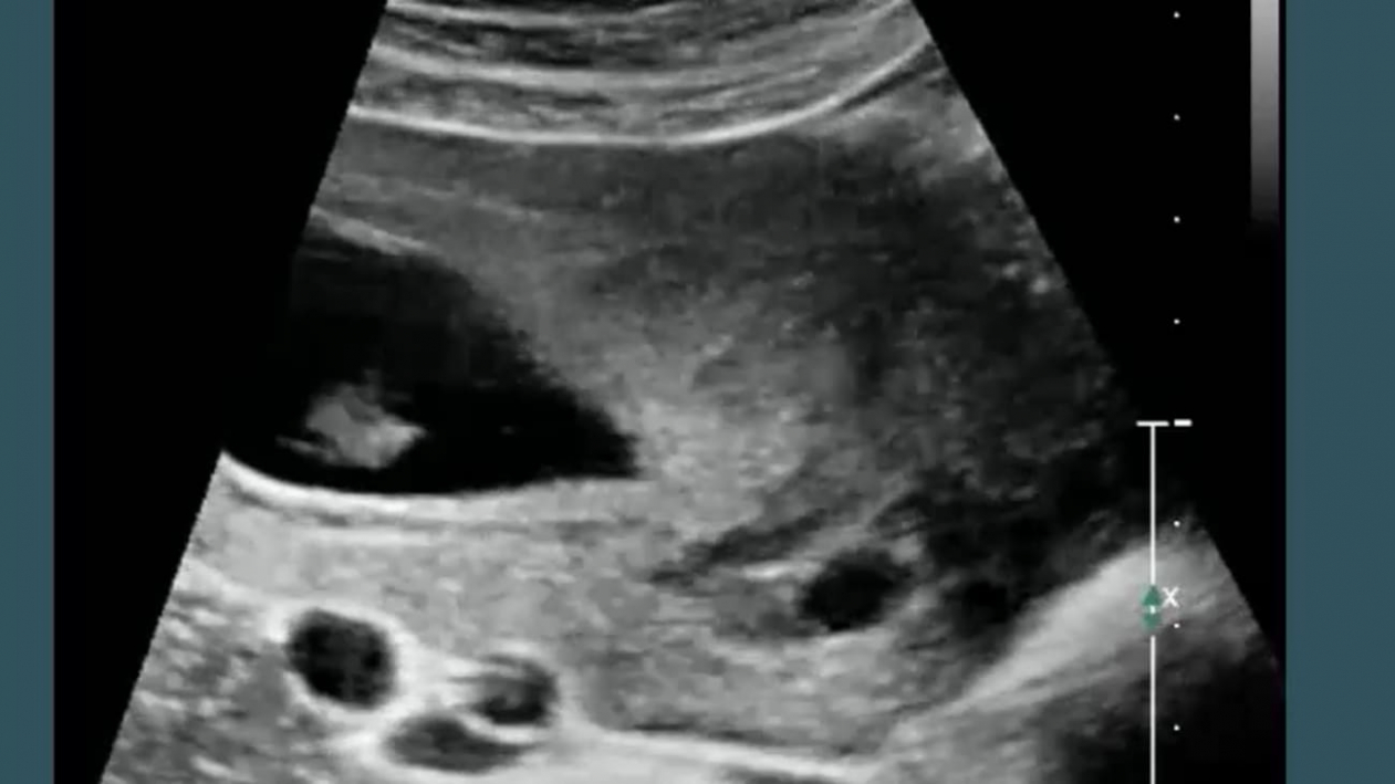 8 Editable First Trimester Ultrasound Report Template Pdf
