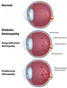 9 Editable Diabetic Eye Exam Report Template Docx